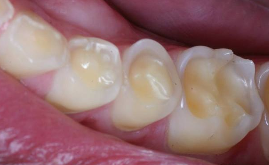 Arte e Face O que é erosão dentária? A erosão dentária é outra doença que, além da cárie, compromete a saúde bucal. No entanto, até pouco tempo atrás essa...
